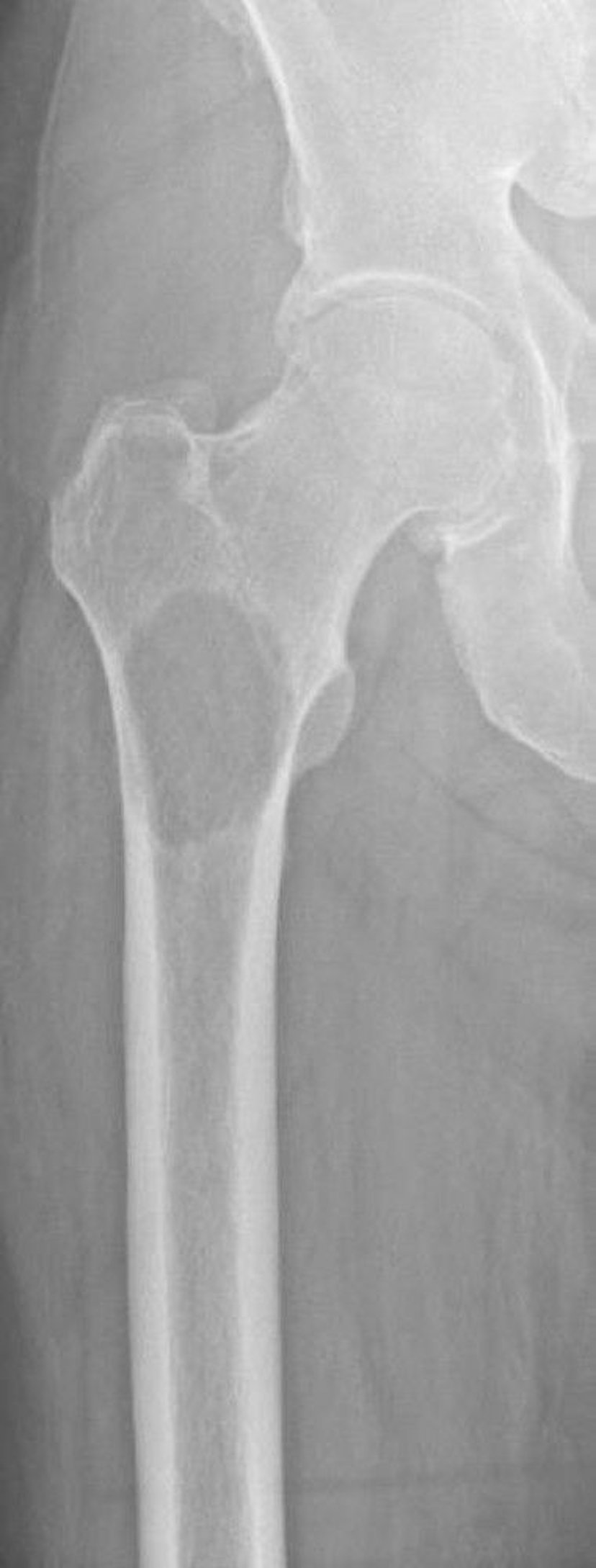 大腿骨近位部の溶骨性転移