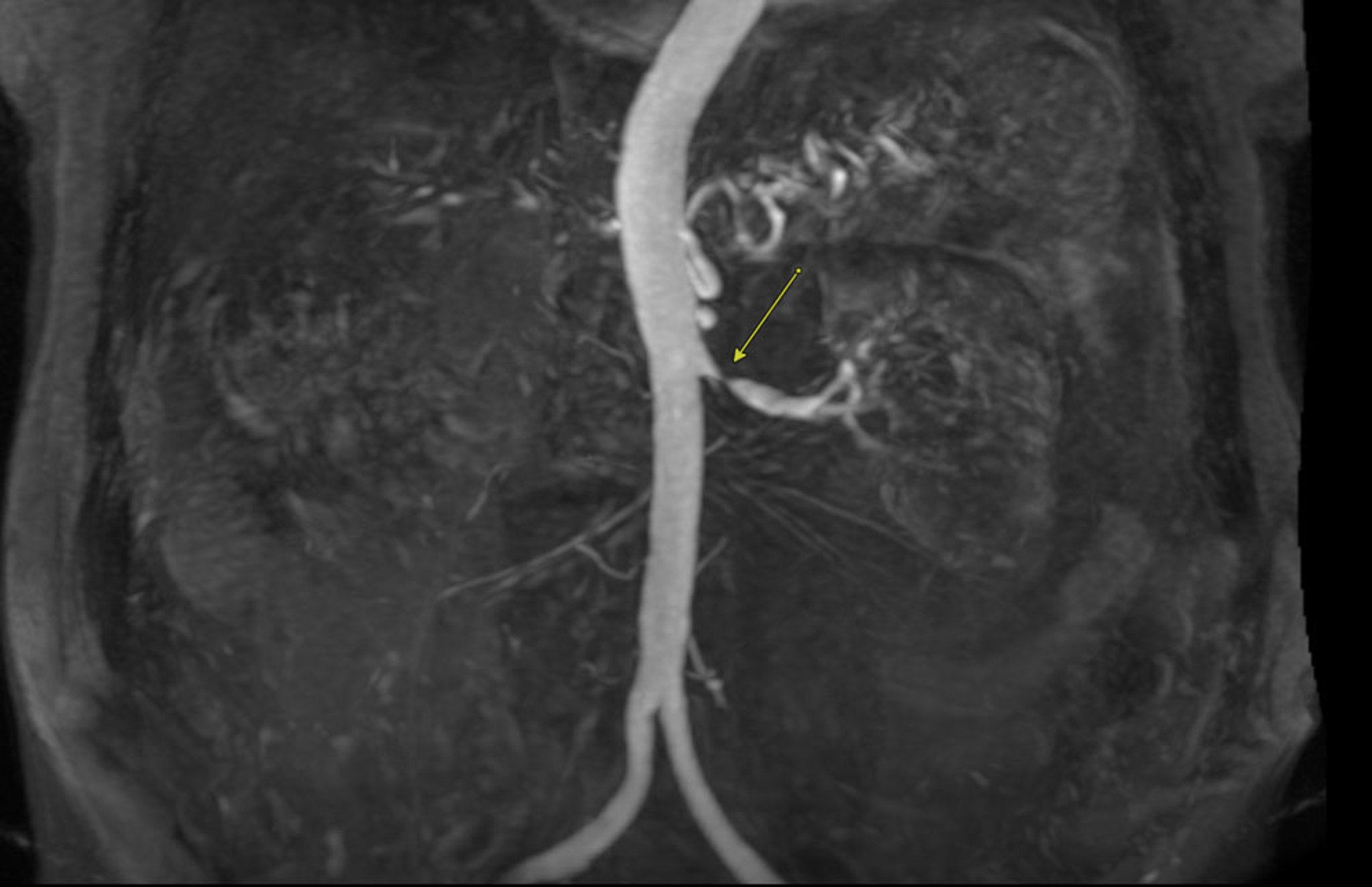含钆基对比剂的磁共振血管成像（MRA）
