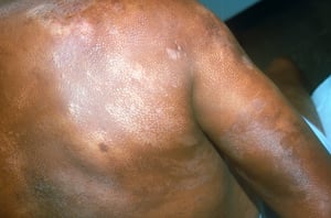 Mycosis fungoides