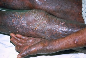 Mycosis fongoïde