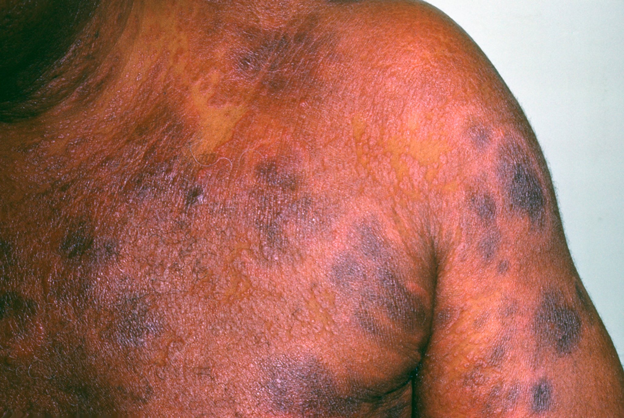 Mycosis Fungoides (3)