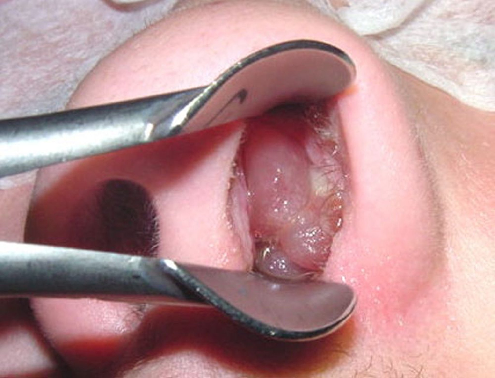 Polype nasal