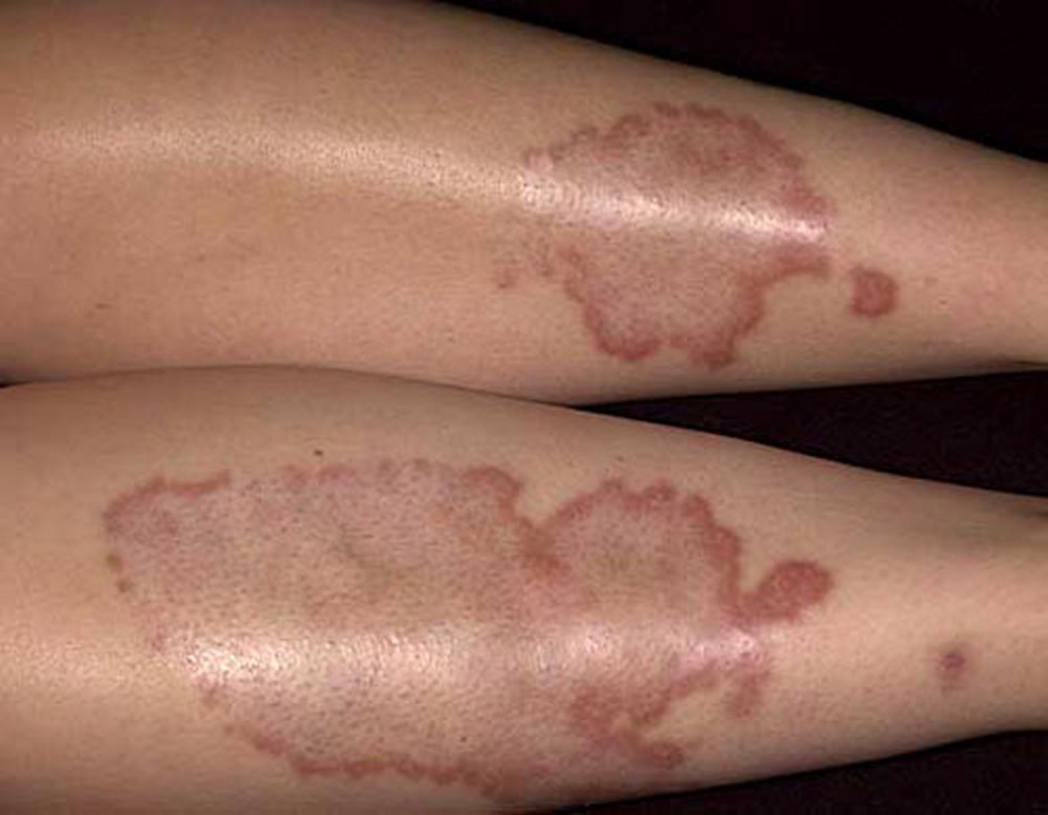 Necrobiosis Lipoidica