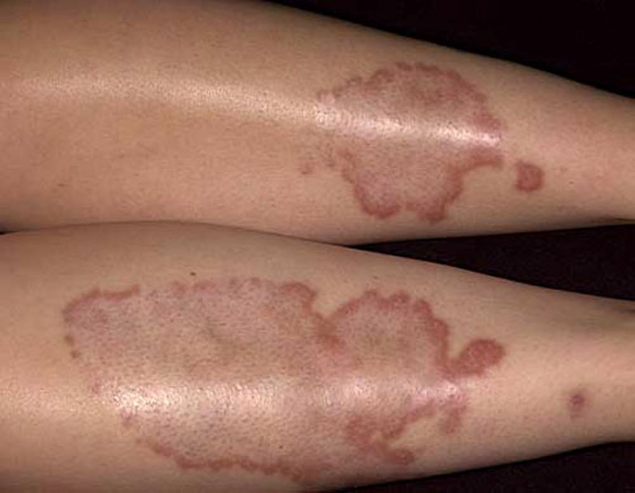 Nécrobiose lipoïdique