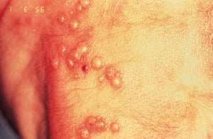 Herpes-simplex-Virusinfektion bei Neugeborenen