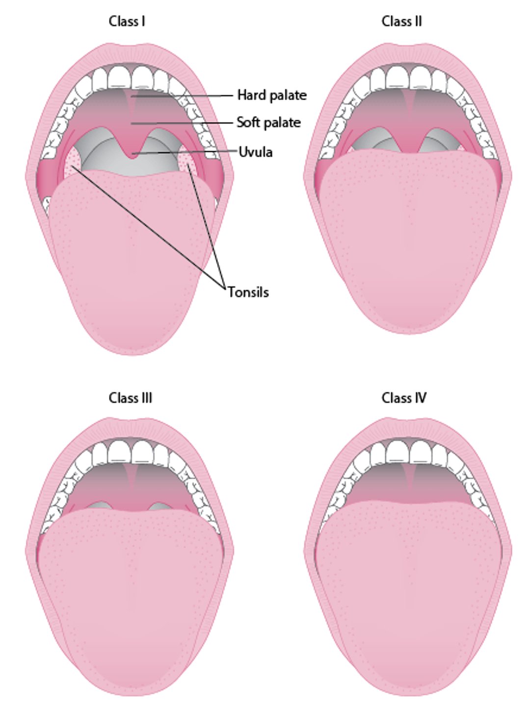 改変Mallampati分類