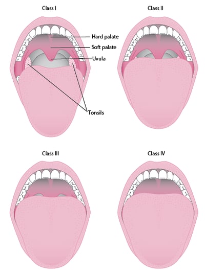 Thang điểm Mallampati sửa đổi
