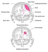 Brain Herniation
