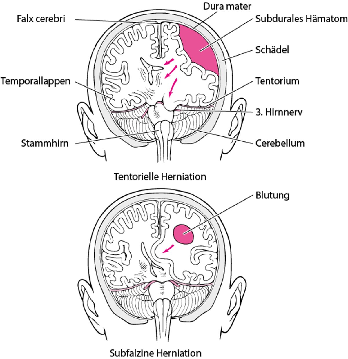 Einklemmung des Gehirns
