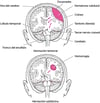 Herniación encefálica