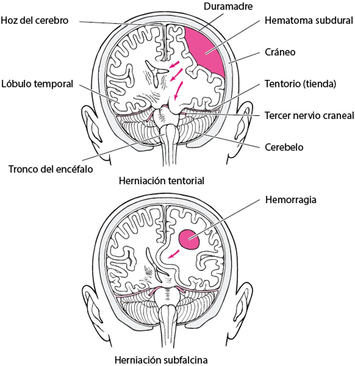 Herniación encefálica