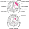 Herniação cerebral