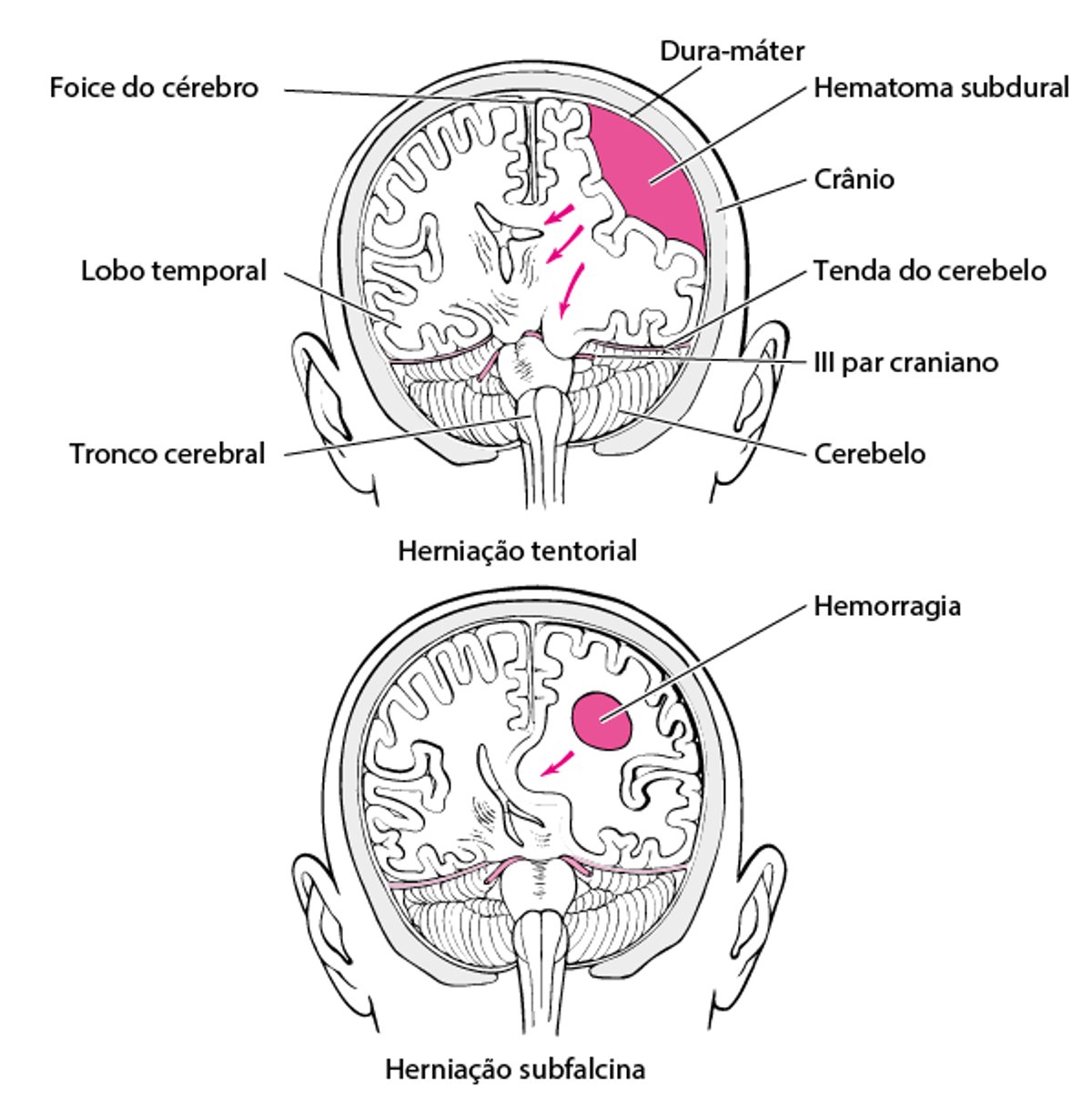 Herniação cerebral