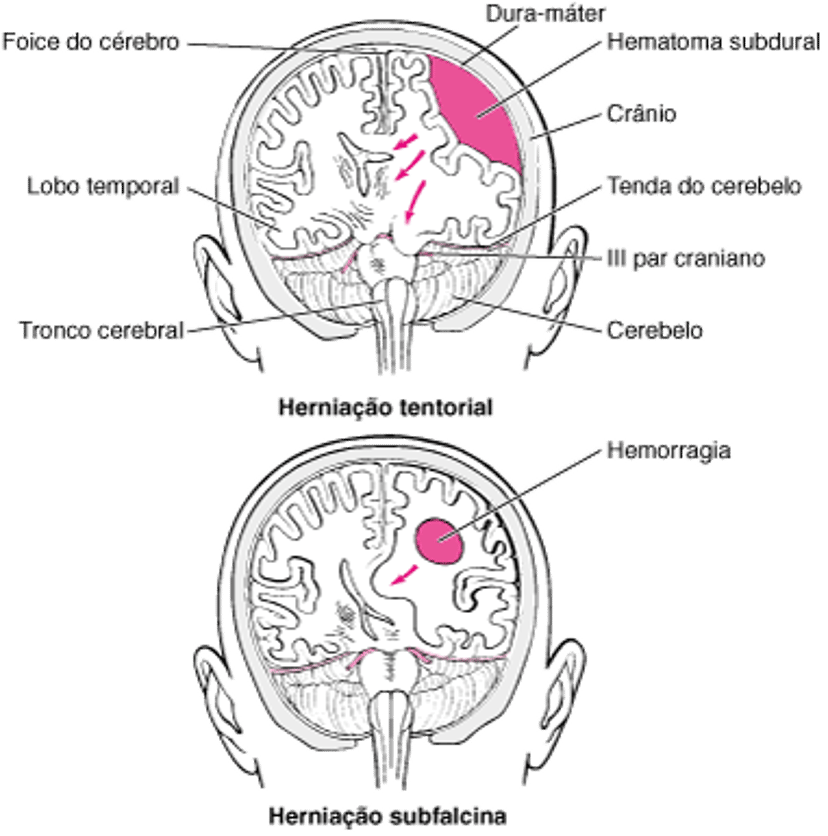 Herniação cerebral
