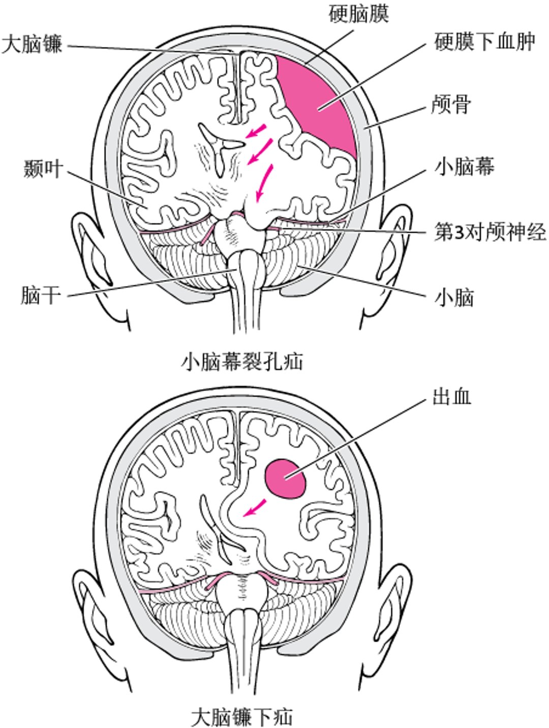 脑疝