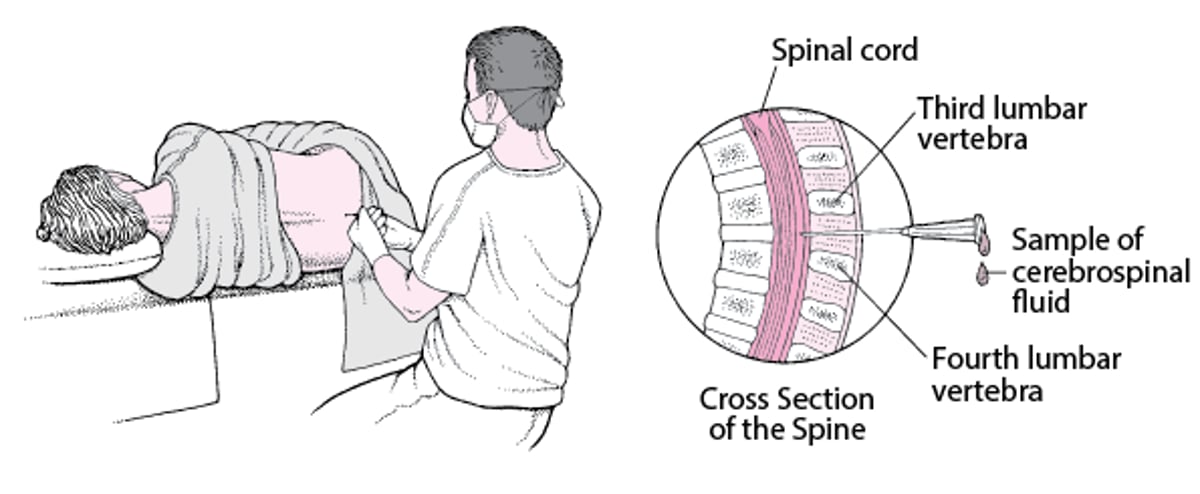 Lumbar Puncture