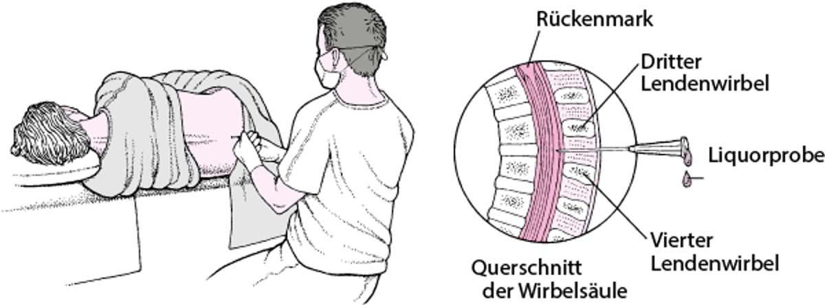 Lumbalpunktion