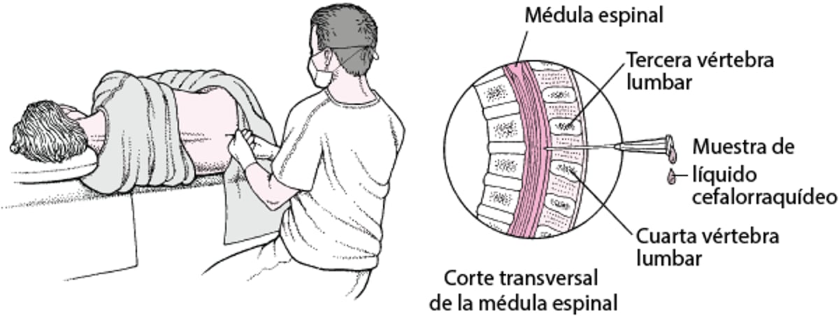 Punción lumbar