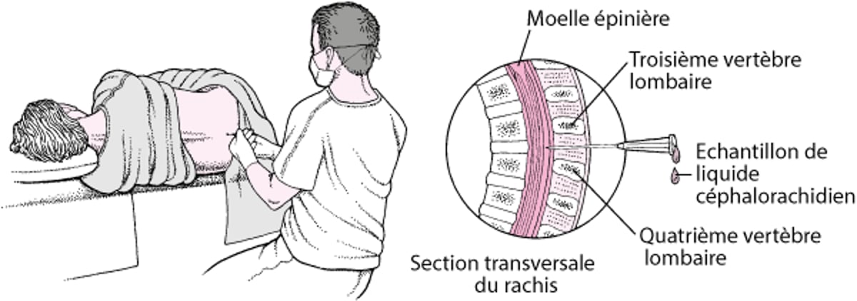 Ponction lombaire
