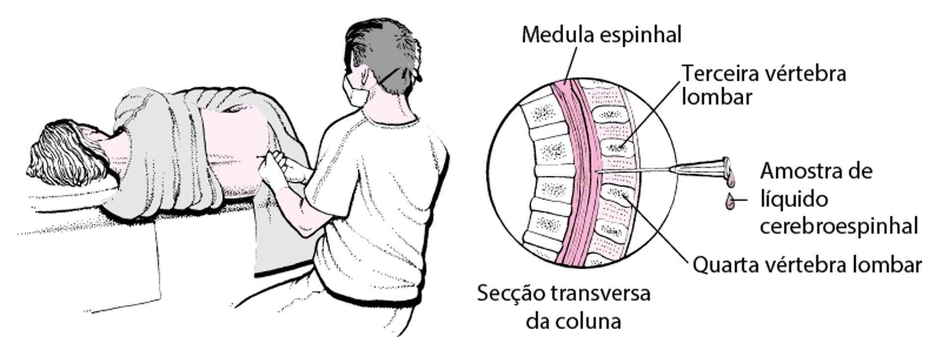 Punção lombar