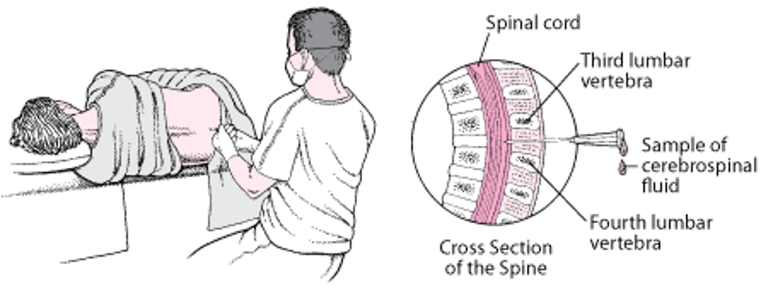 Люмбальная пункция