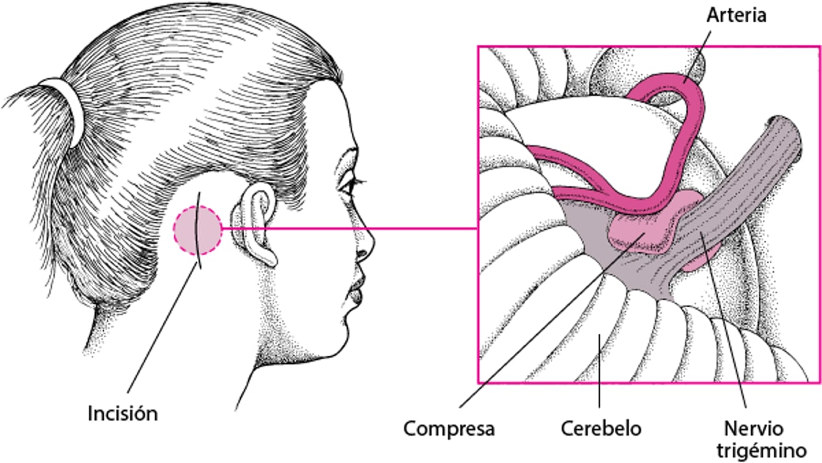 Descompresión microvascular
