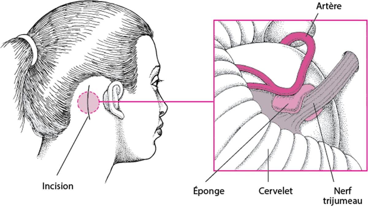Décompression microvasculaire