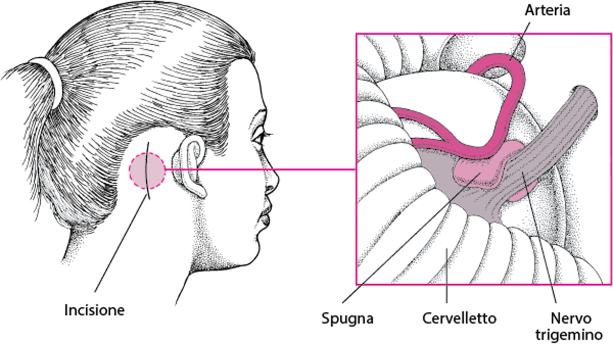 Decompressione microvascolare