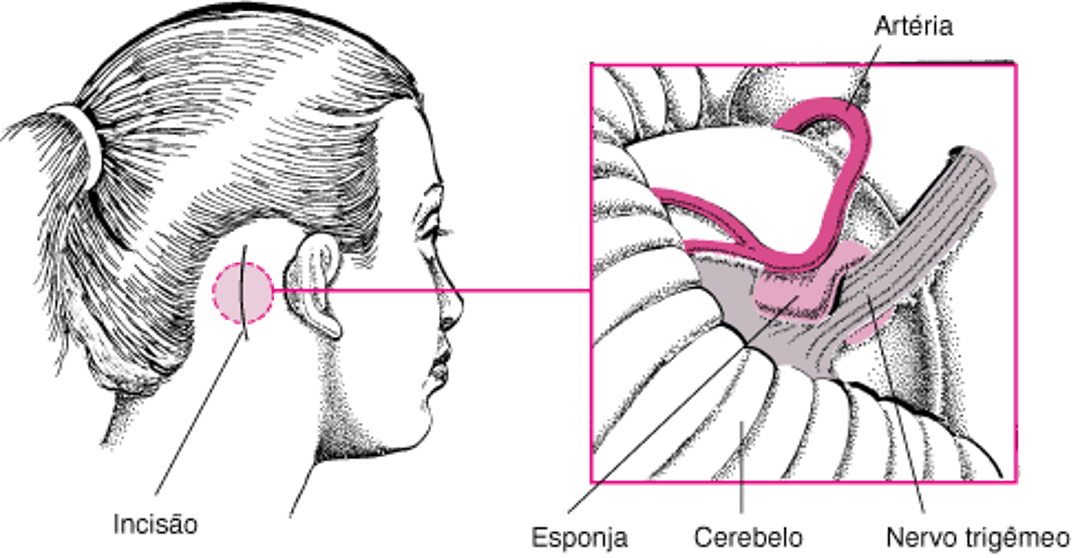 Descompressão microvascular