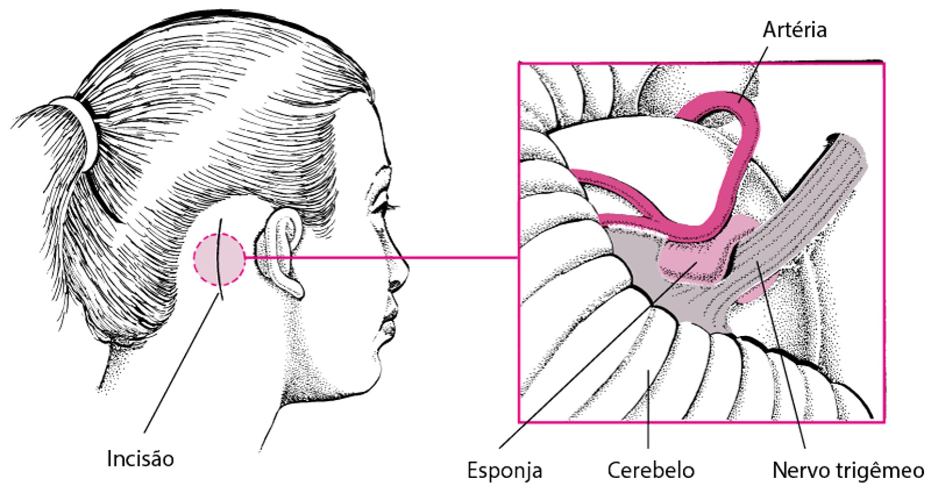 Descompressão microvascular