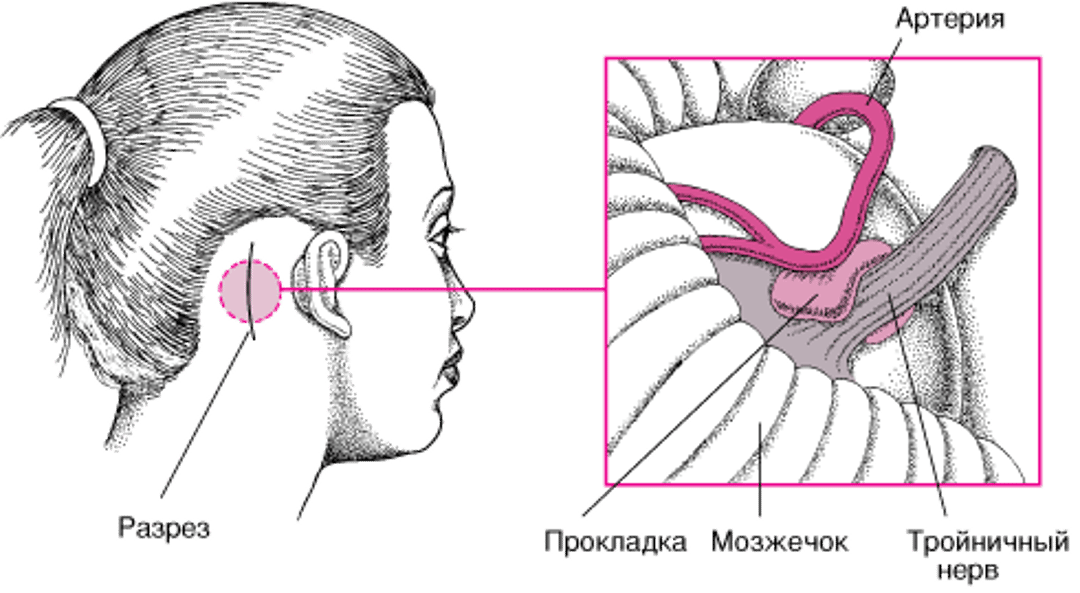 Микроваскулярная декомпрессия