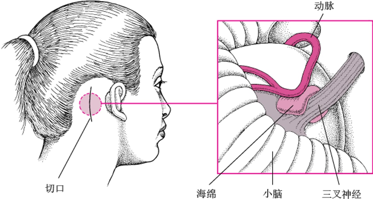 微血管减压术
