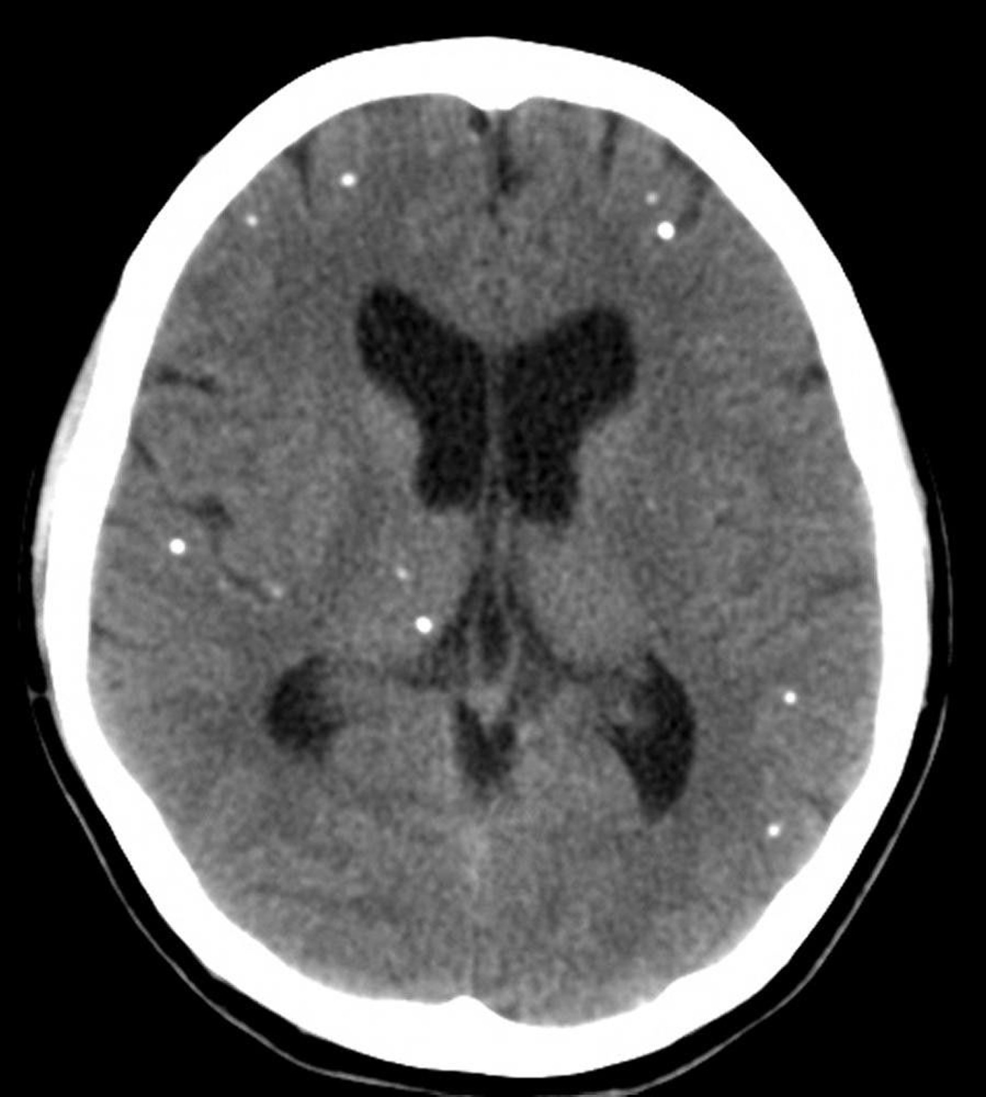 Neurocysticercosis