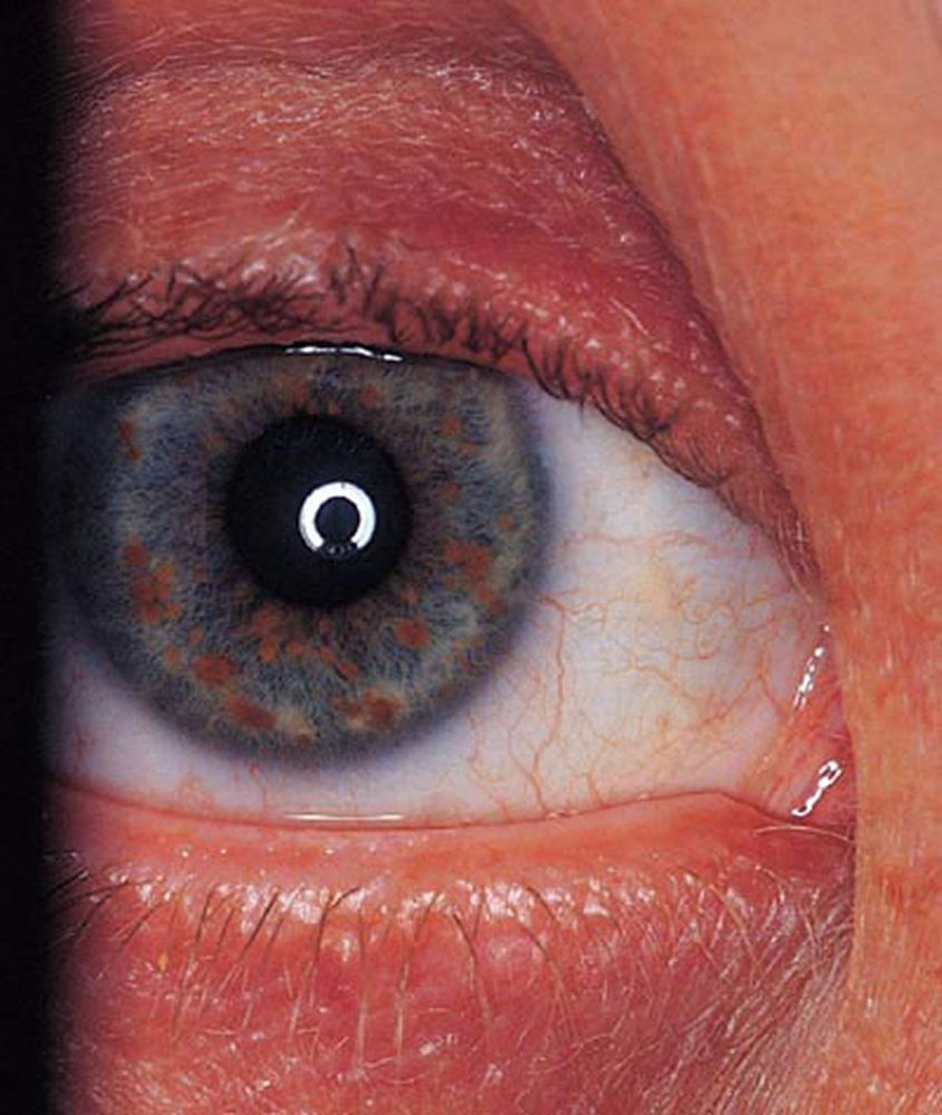 Neurofibromatosi (noduli di Lisch)