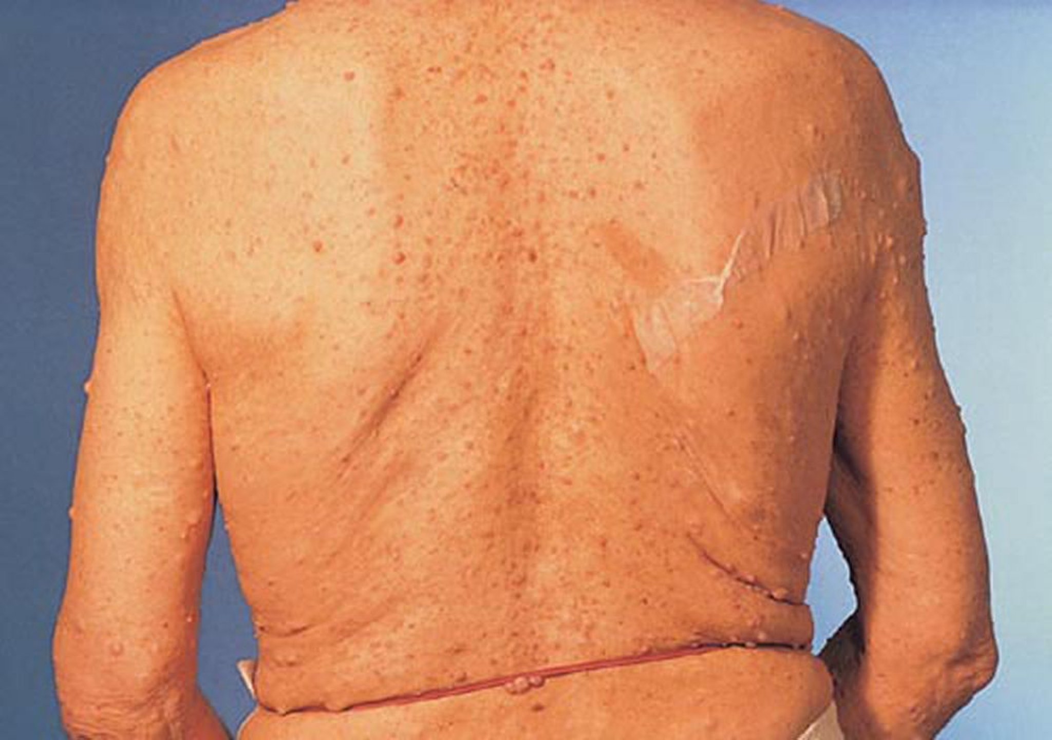 Neurofibromatosis (Neurofibromas)