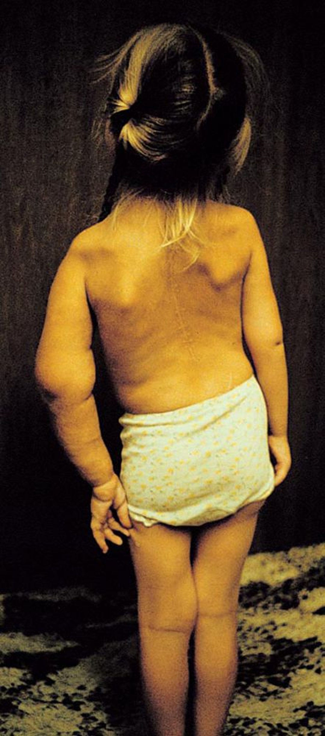 Neurofibromatosis (anomalías esqueléticas)