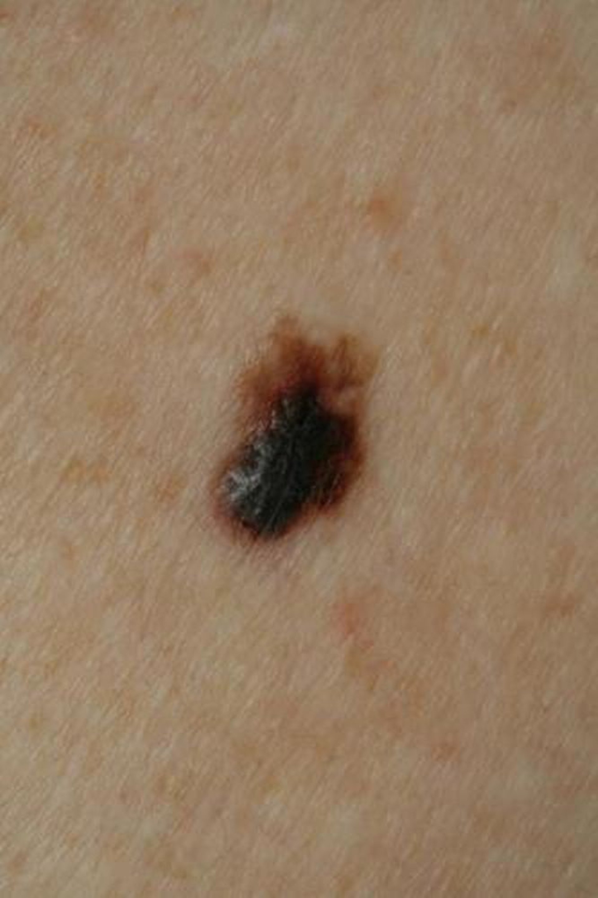 Melanoma nodular
