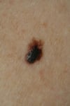 Melanoma nodulare