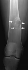 Nonossifying Fibroma