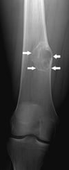 Fibroma no osificante