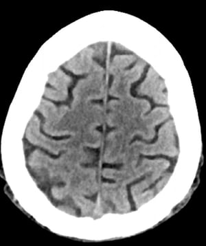 Chụp CT đầu bình thường (người lớn, 74 tuổi) – Lát cắt 1