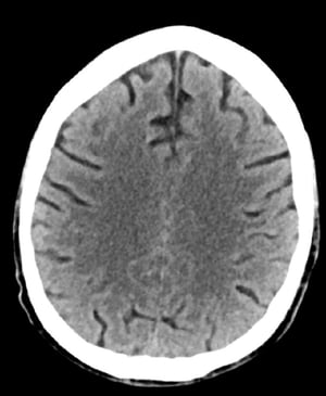 Chụp CT đầu bình thường (người lớn, 74 tuổi) – Lát cắt 2
