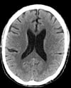 Normal Head CT Scan (Adult, Age 74) – Slide 4