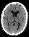 Normal Head CT Scan (Adult, Age 74) – Slide 5