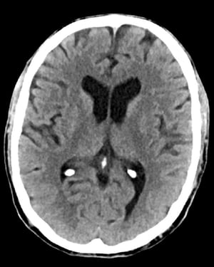Chụp CT đầu bình thường (người lớn, 74 tuổi) – Lát cắt 5