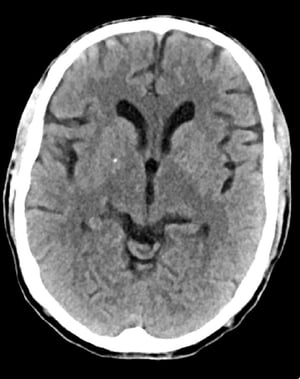 Chụp CT đầu bình thường (người lớn, 74 tuổi) – Lát cắt 6