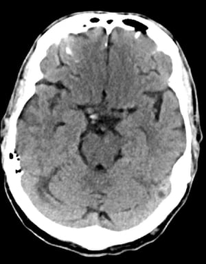 Chụp CT đầu bình thường (người lớn, 74 tuổi) – Lát cắt 7