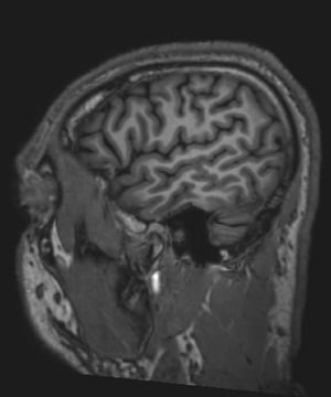 Normales MRT des Gehirns (sagittal) – Folie 1