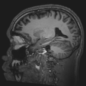 Normales MRT des Gehirns (sagittal) – Folie 2)