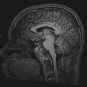 Normales MRT des Gehirns (sagittal) – Folie 3)